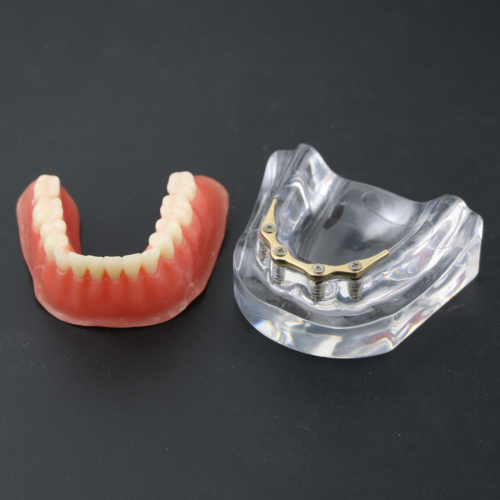 Dental Teeth Implant Model Inferior Overdenture 4 Implants Denture Demo Training