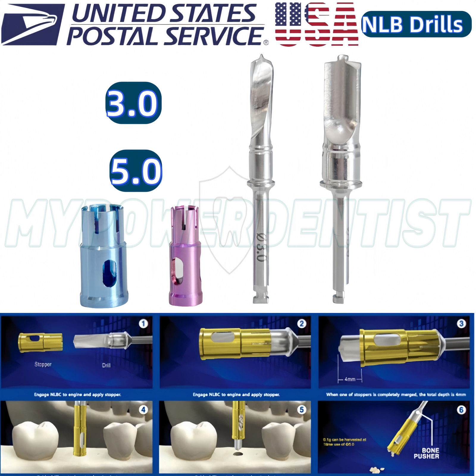 ∅5.0 3.0 Dental Drill Harvest Collector Never Loss Trephine NLB Drill