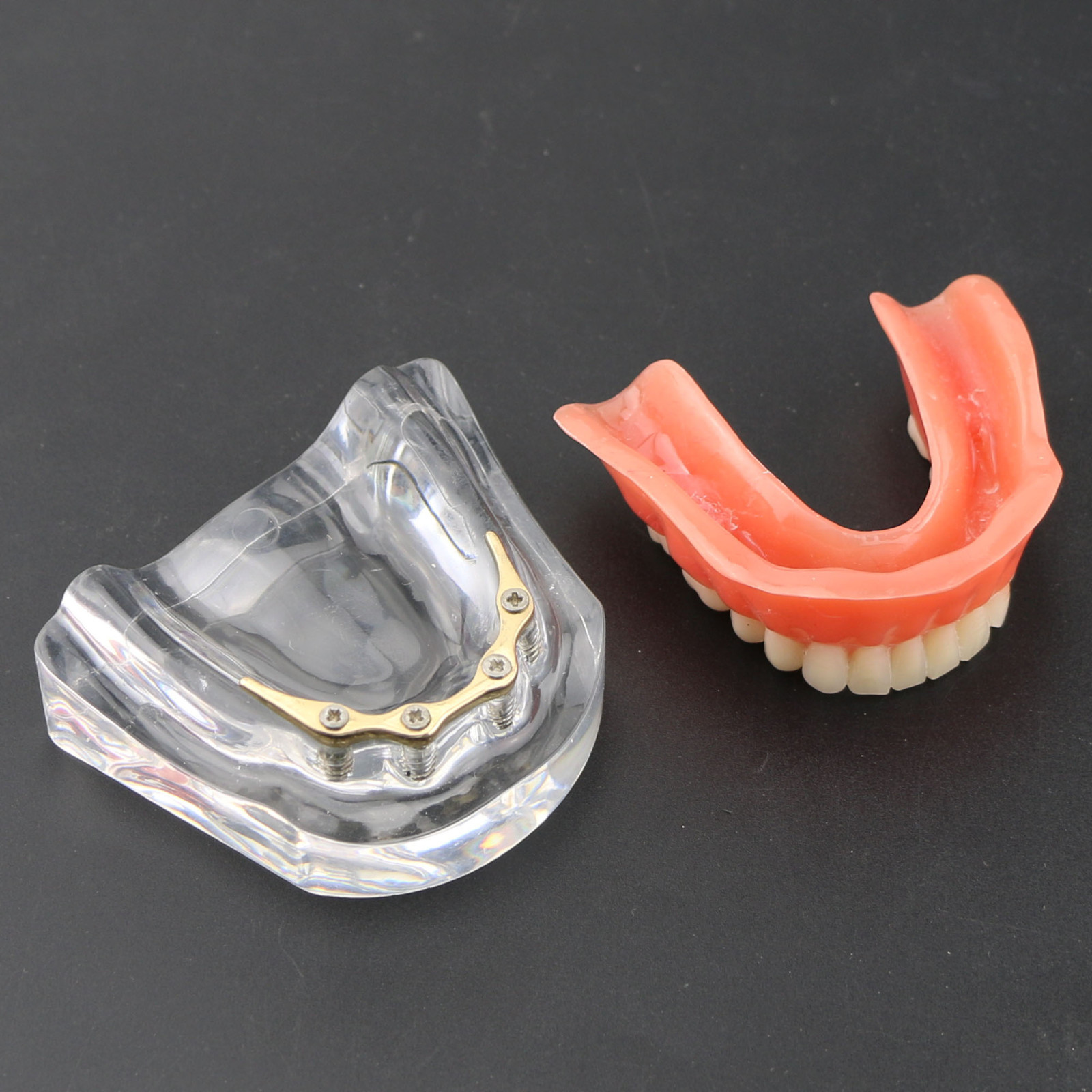 Dental Teeth Implant Model Inferior Overdenture 4 Implants Denture Demo Training