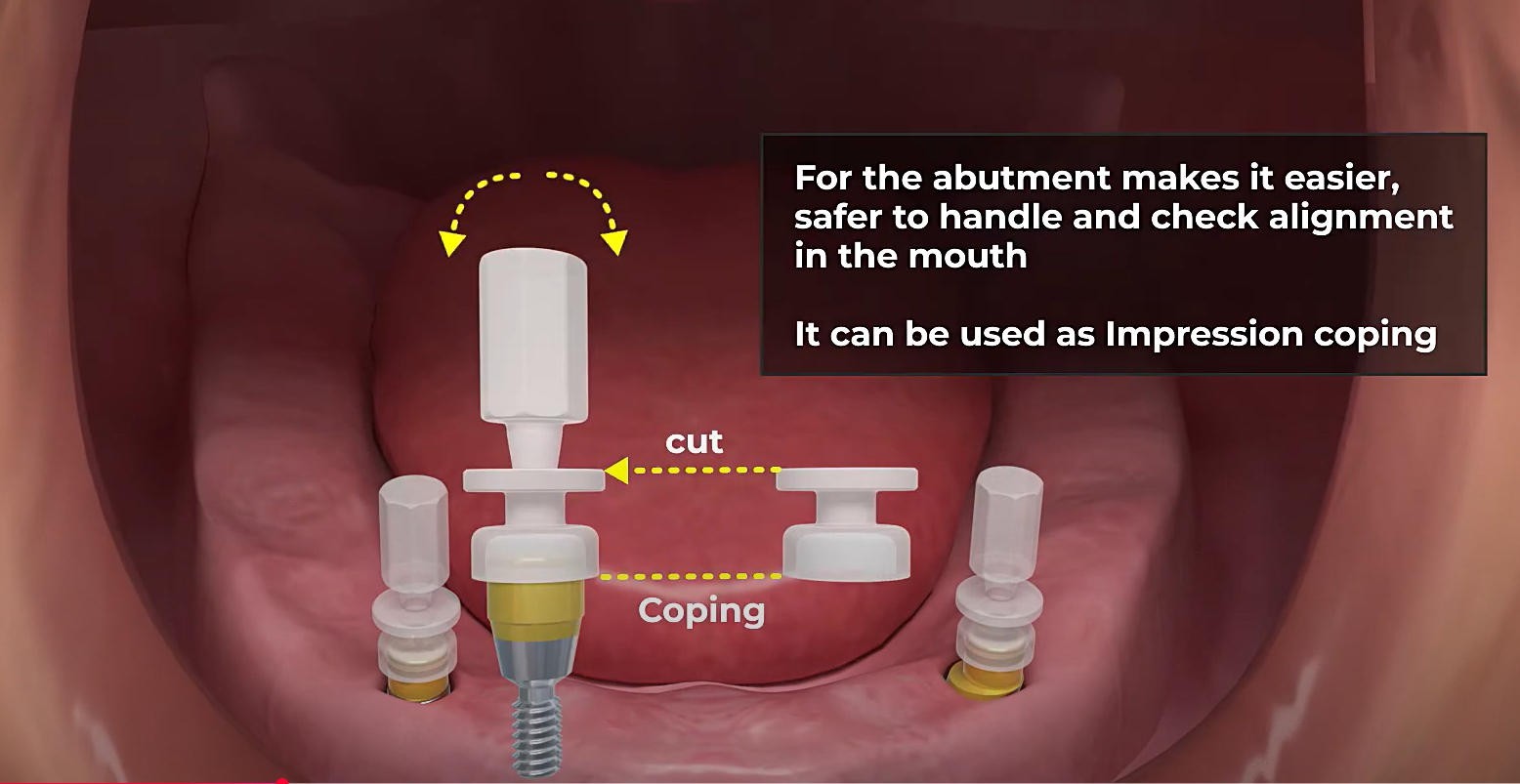Locator Overdenture Abutment Fit Hiossen ET MINI/Regular Zest Classic Male Cap