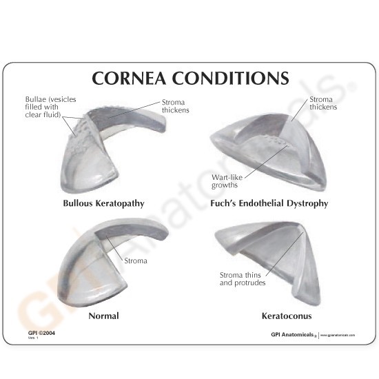 Eye Cataract Cornea Eye Set of 3 GPI Anatomy Models #4021 Make Offer! SEE VIDEO