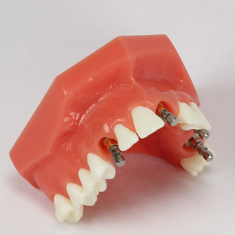Dental Upper Jaw Implant Model (Red) with 5 implant #2012 01