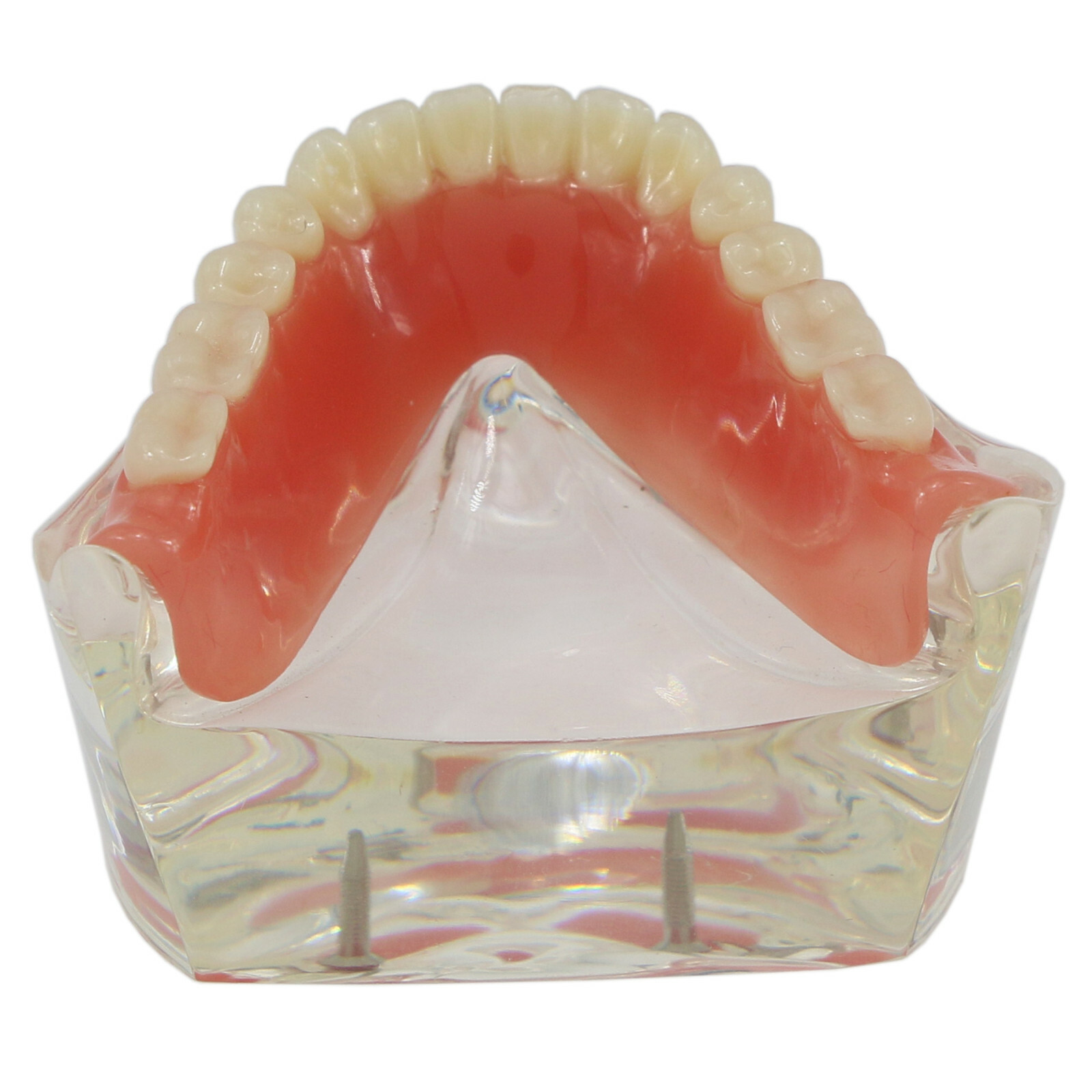 Dental Typodont Teeth Model Overdenture Lower Inferior 2 Implants Demo M-6002 US