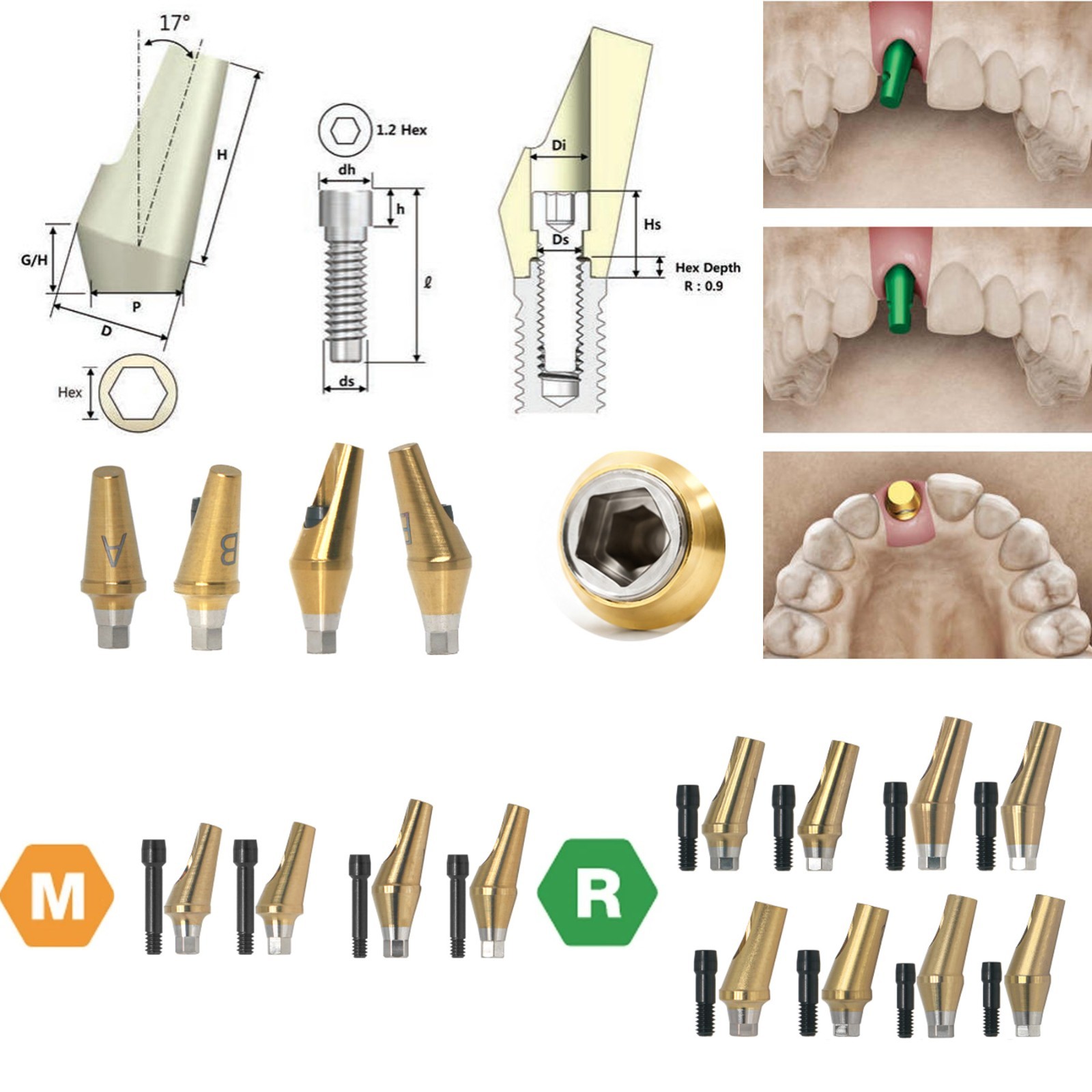 US Dental 17° Angled Abutment For Hiossen ET III Osstem TS Mini Regular Platform