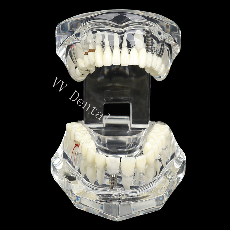 Dental Disease Model Teeth Teach Study Oral Teeth Bridge Restoration Pathology