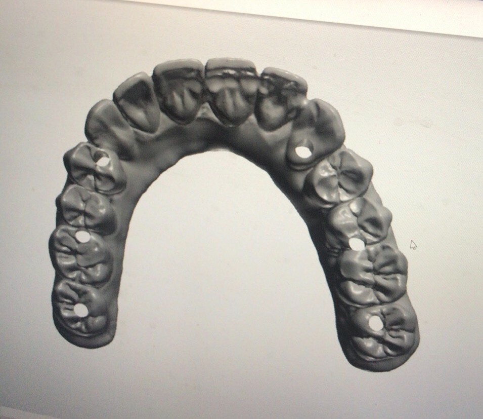 Crown & Bridge & Implant abutment Design Service & Digital CAD/CAM 