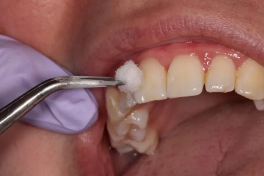 Waldent Hemostatic Liquid consisting of 25% aluminium chloride for OGB control