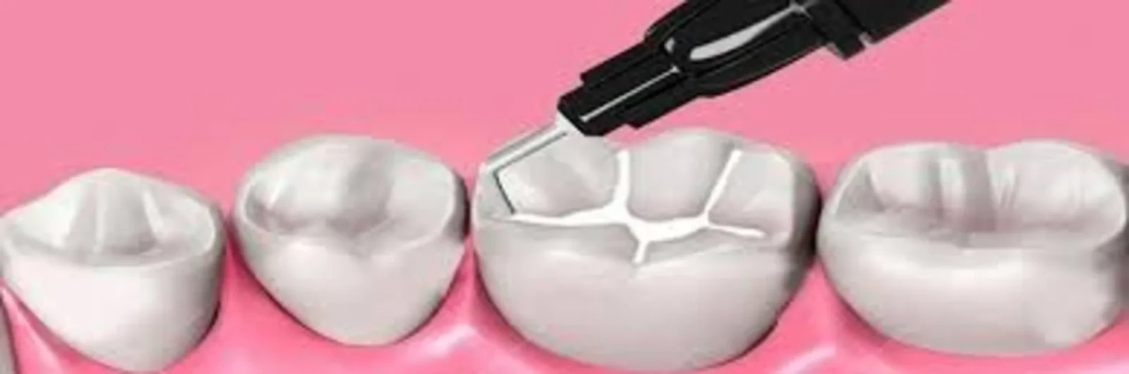 Dental SDI WAVE Fluoride Release Nano Filler High Strength Flowable Composite 1g