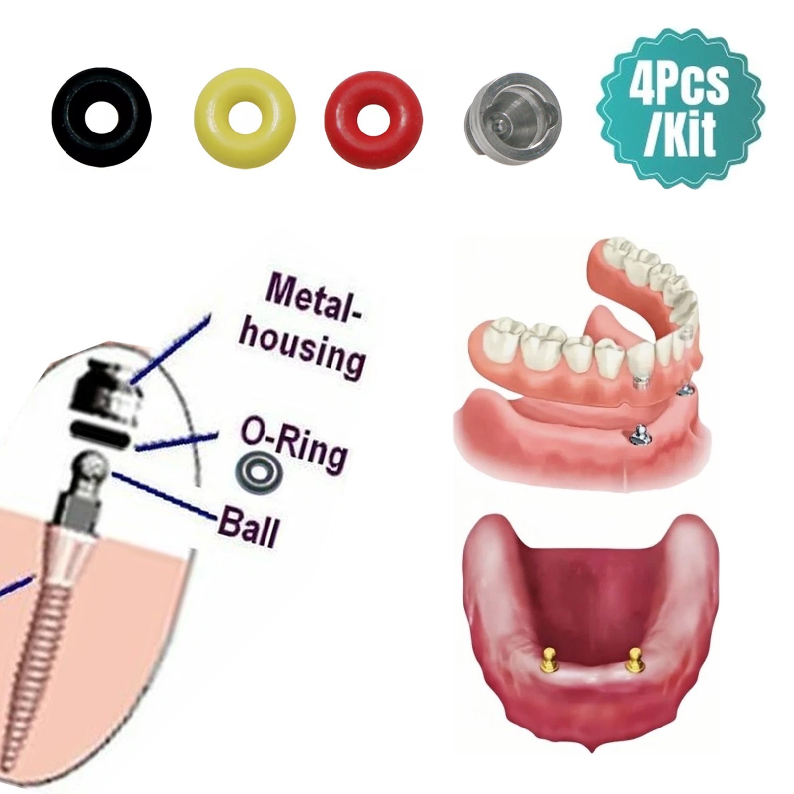 Dental O-Ring Retention Cap Ball Attachment Fit Hiossen Osstem Implant 4Pcs/Set