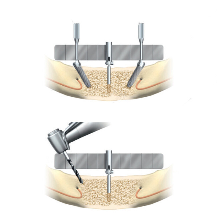 Dental Implant Locating Guide Ruler Surgical Planting Positioning Locator Gauge