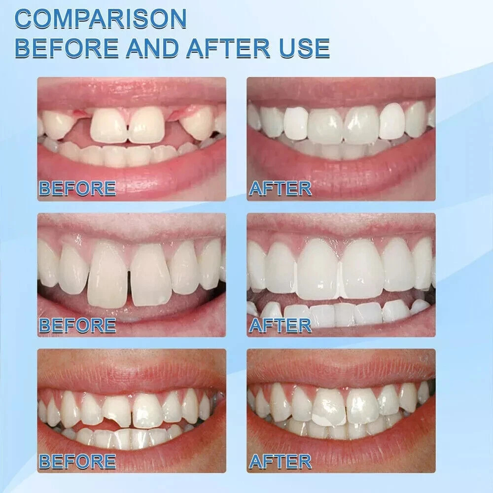 Dental Thermal Fitting Beads Replacement Temporary Tooth Denture 25g Material