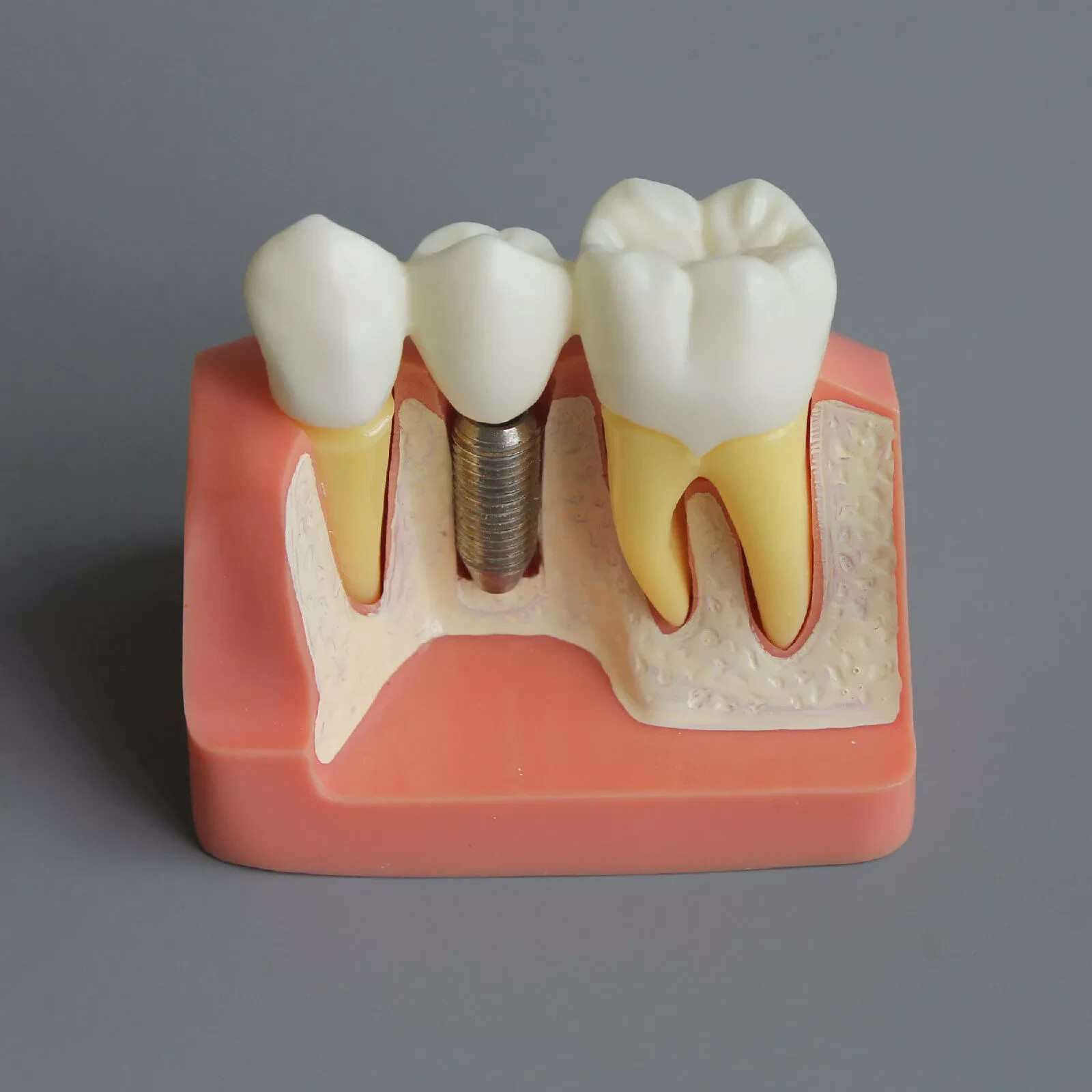 2Pc Dental Oral Analysis Crown Bridge Demonstration Tooth 4 Times Model Typodont