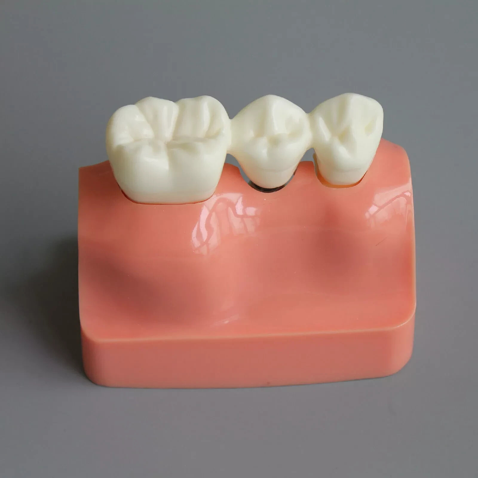 2Pc Dental Oral Analysis Crown Bridge Demonstration Tooth 4 Times Model Typodont