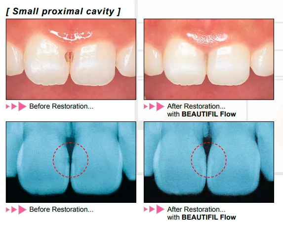 Shofu Beautifil Flow F02 Refill Flowable composite for restoring cervical areas