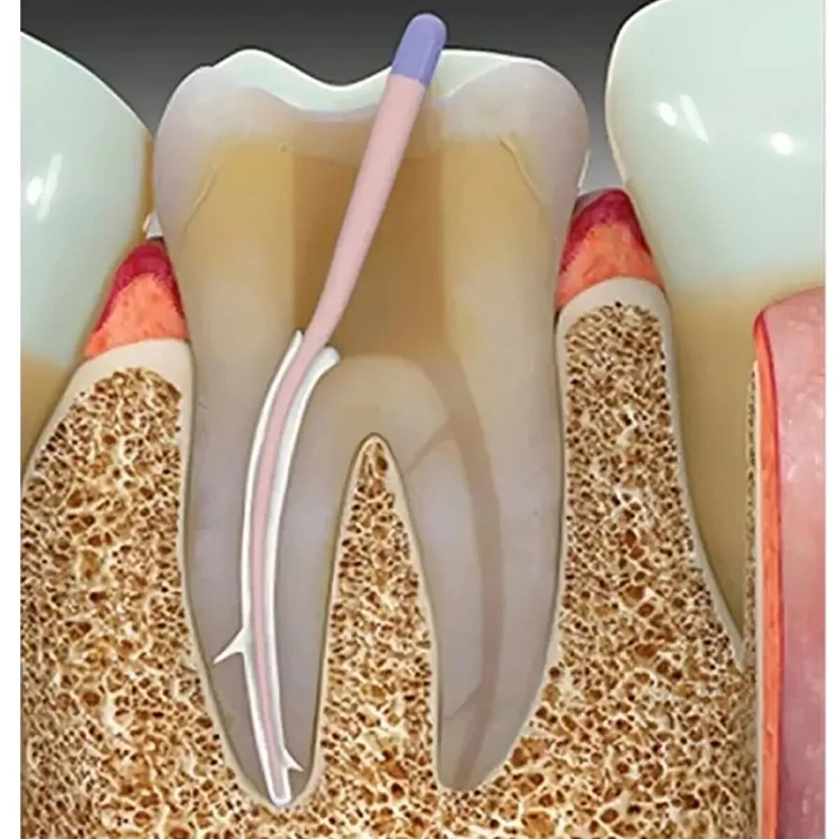 Diadent Dia Proseal Resin Based Radiopacity Material for Root Canal Sealing