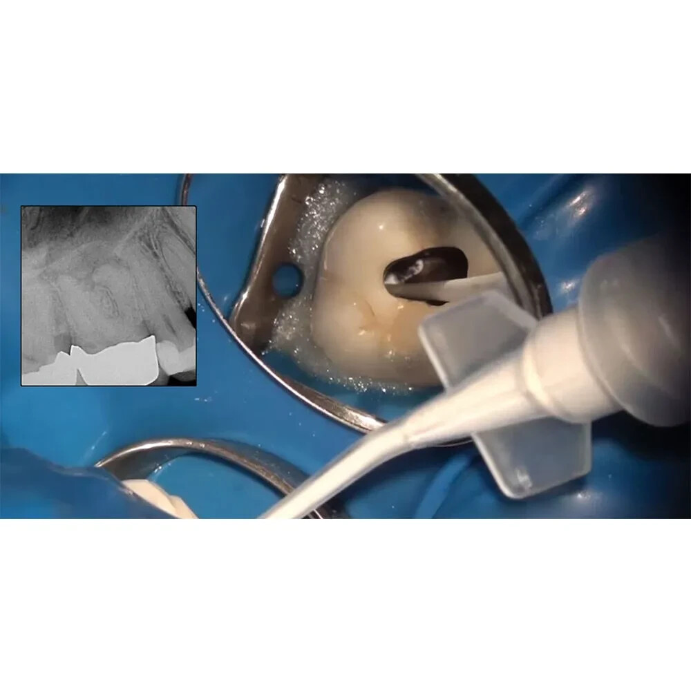 Prime Dental MTA Bioceramic Root Canal Sealer Syringe Tips for Dental Procedures