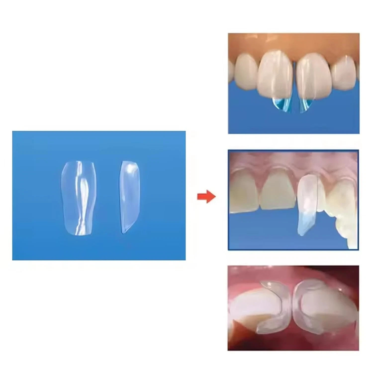 Dental Clear Transparent Matrix Anterior Matrices Bow BT Matrices Fits Bioclear