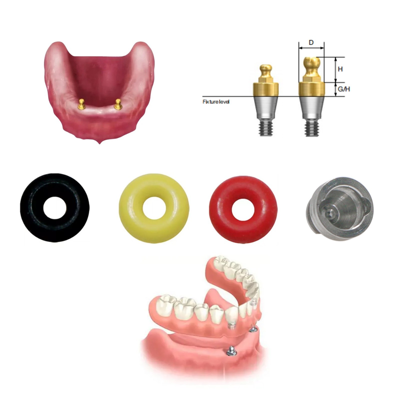 US Dental O-ring 4Pcs/Set for Ball Attachment Abutment Compatible Hiossen Osstem