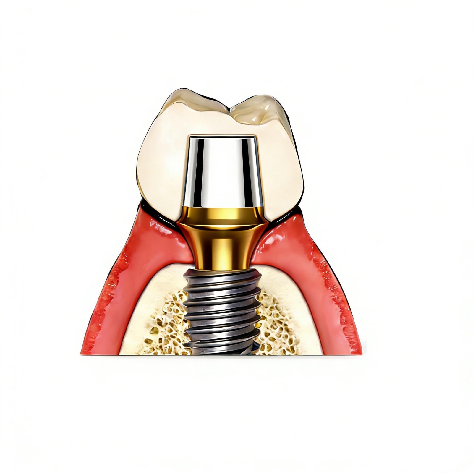 US Dental Ti Standard Straight Abutment W/Replica Screw fit Hiossen ET Regular