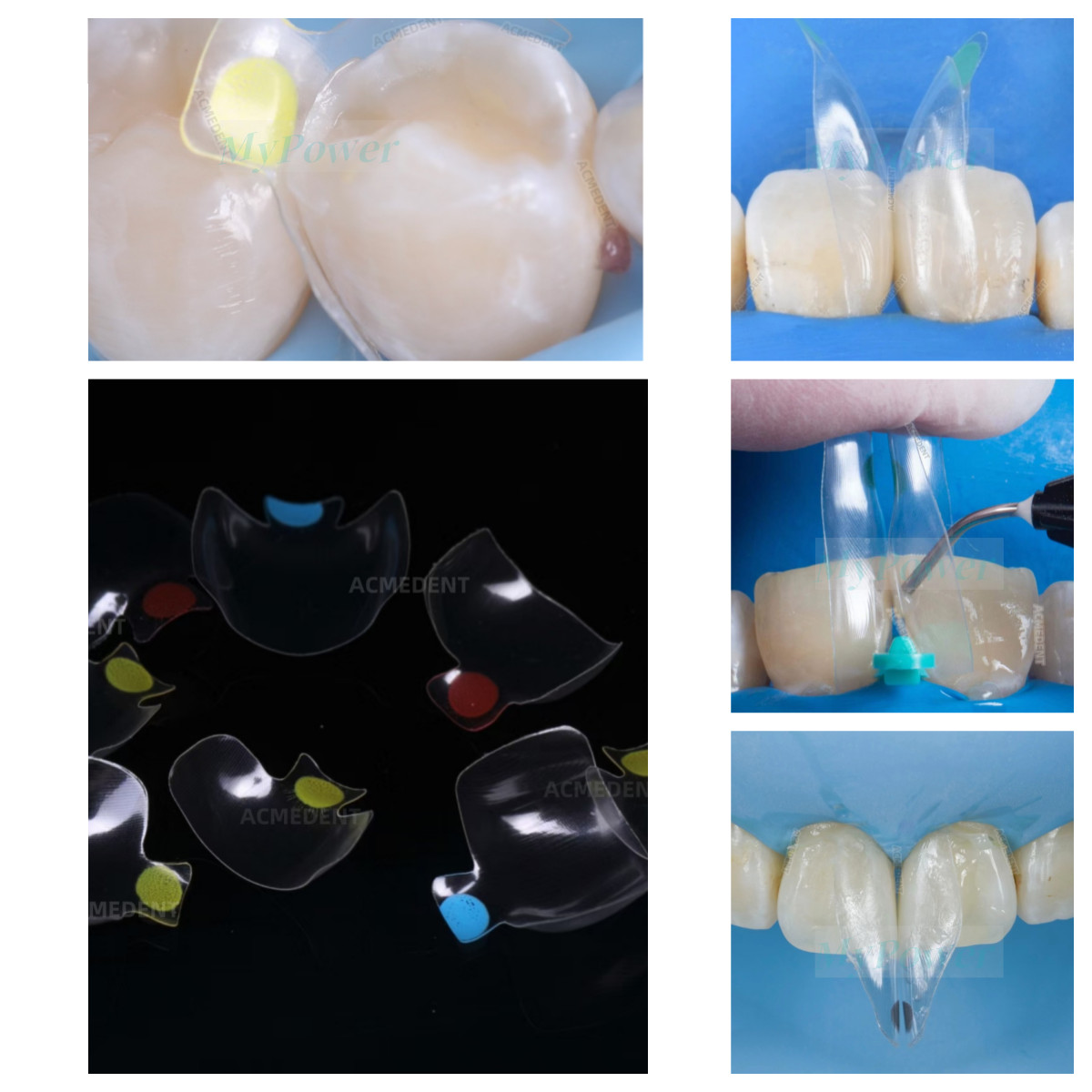 Dental Clear Matrix Anterior/Posterior Teeth Transparent Matrix Fit Bioclear BT