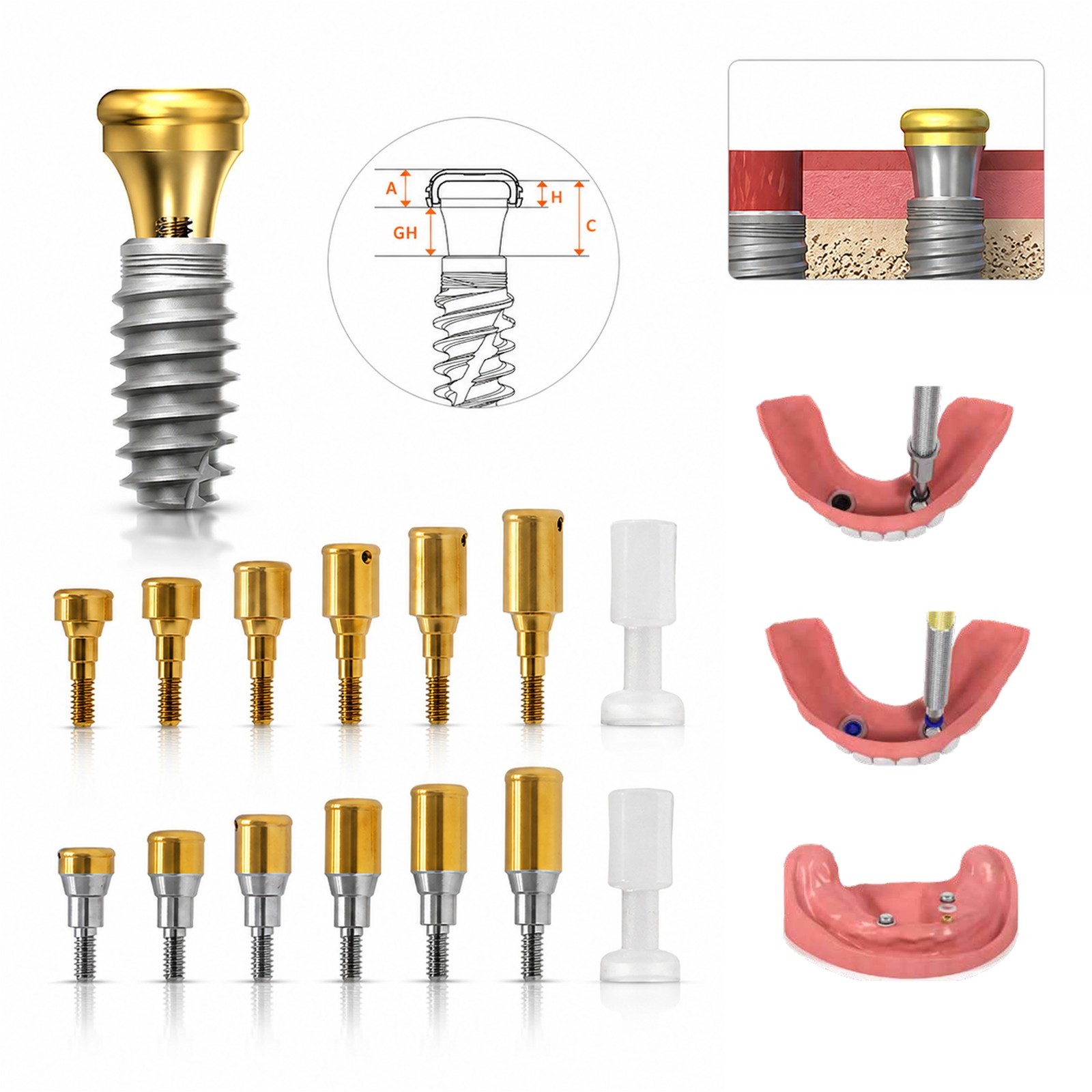 ZEST Legacy Locator Overdenture Abutment Hiossen Nobel Straumann Zimmer Neodent