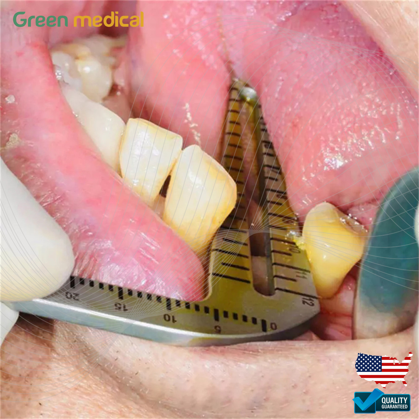 Dental Implant Gauge Surgical Drilling Guide Locator Parallel Depth Pin 5pcs