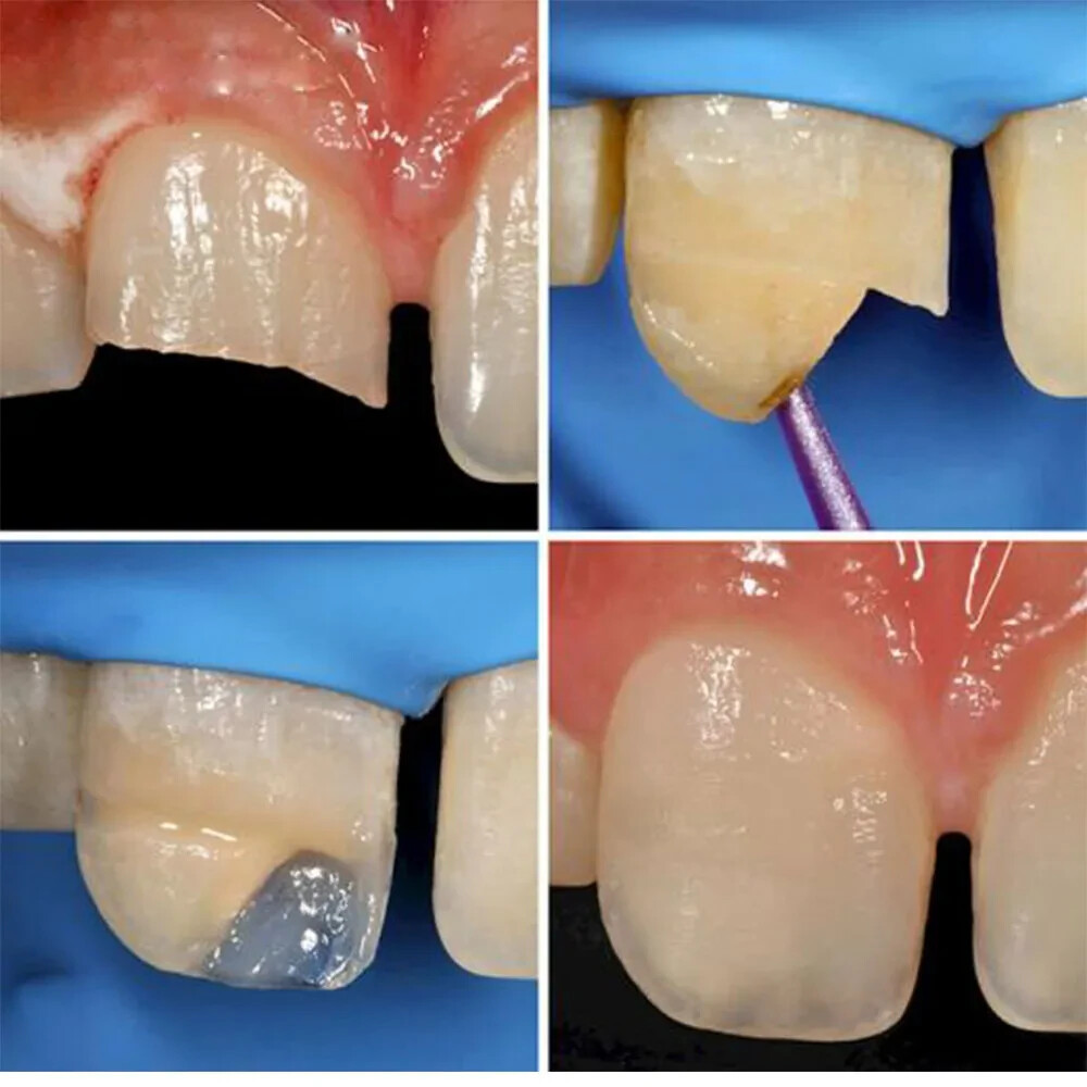 Dental ESTELITE SIGMA QUICK Resin Based Restorative Material 3.8gm Composite A2