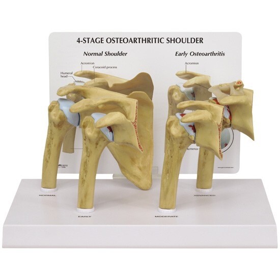 GPI Anatomical – #1800 4-Stage Osteoarthritis Shoulder Anatomy Model