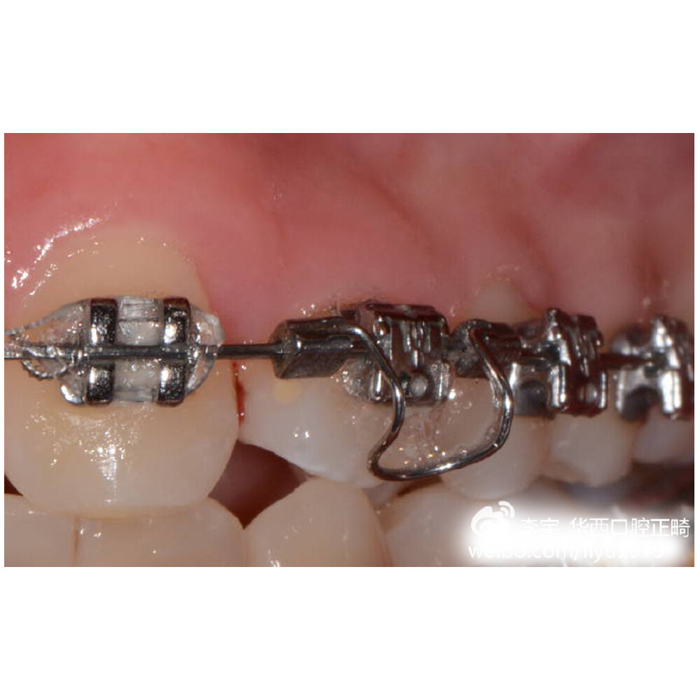 J&J Ortho™ Dental Orthodontic Archway Torquing Arch Spring (10/pk)