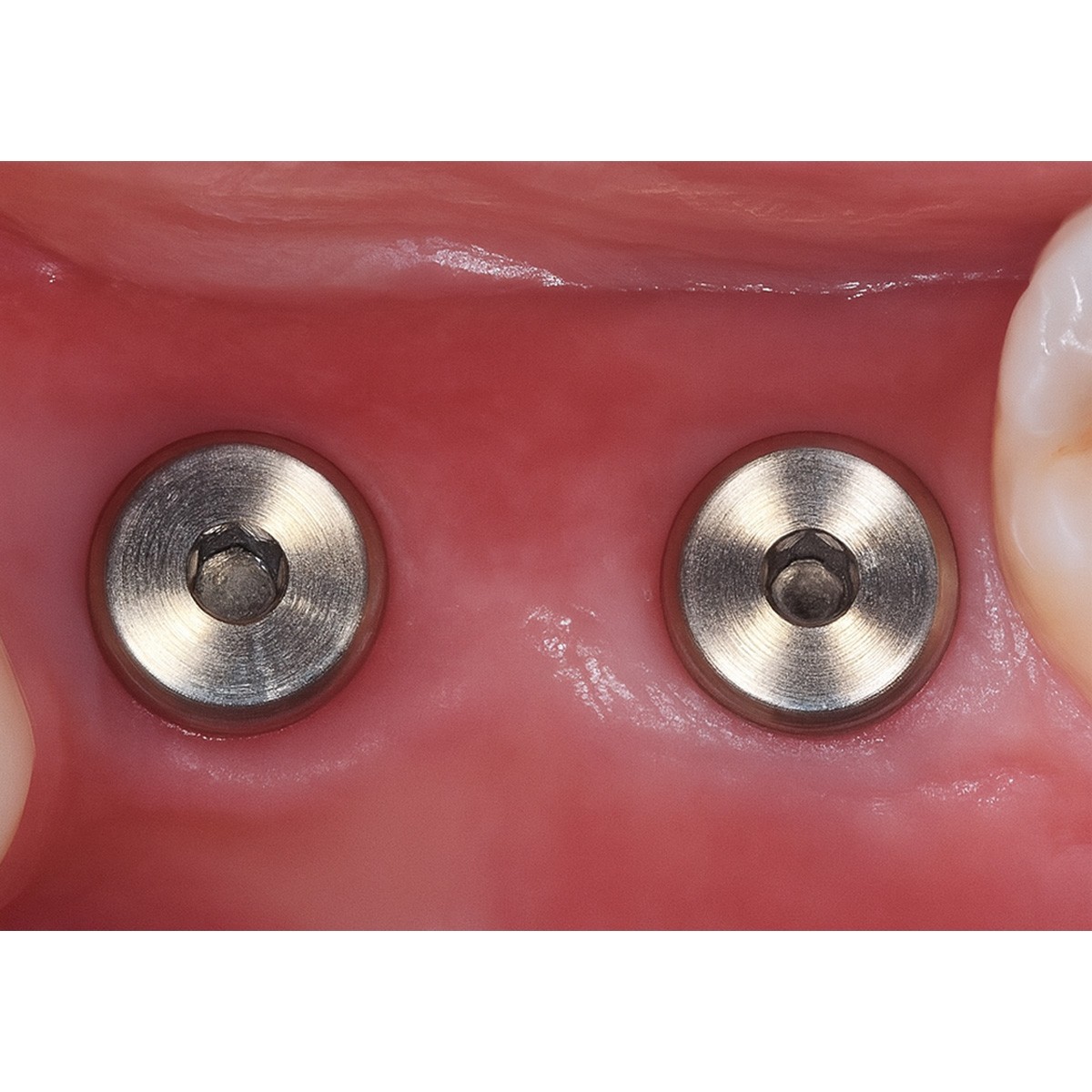 Dentaltech Nobel RP Implant CompatibleGC Dentin Conditioner Healing Abutments