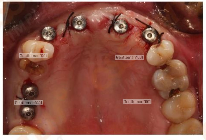 Dental Implan Healing Abutment Caps Cover Screw Mini Regular Platform Titanium