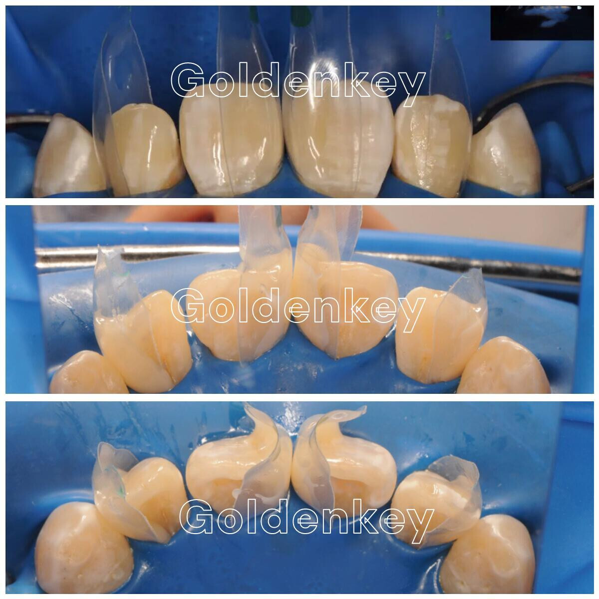 30Pcs Dental Clear Matrix Front Teeth Anterior Matrices BT Fits Bioclear TOP BM