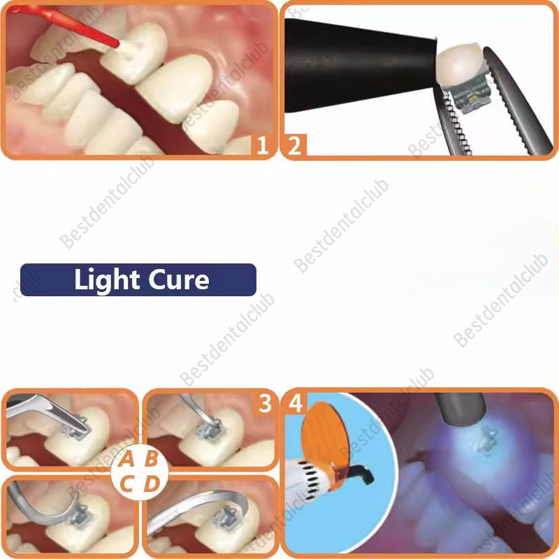 Dental Orthodontic Light Cure Adhesive Bonding Metal Brackets Etch Braces L-Kit