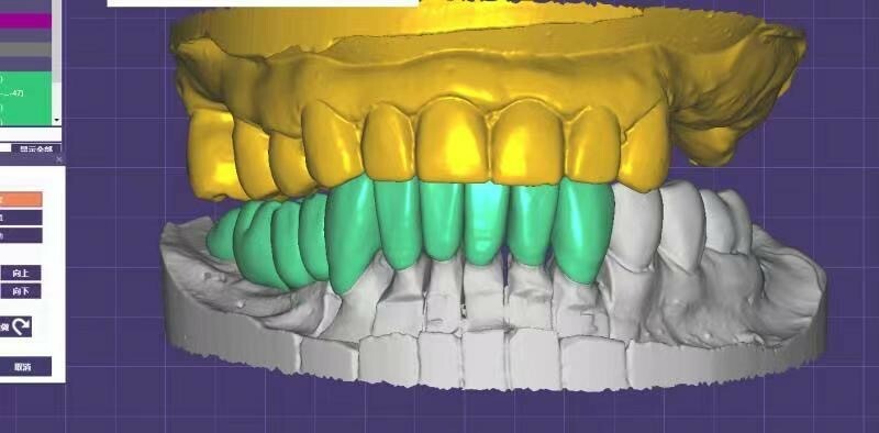 Crown & Bridge & Implant abutment Design Service & Digital CAD/CAM 