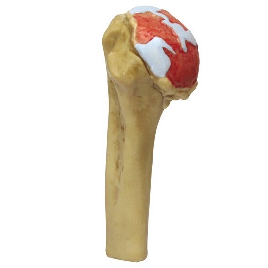 GPI Anatomical – #1800 4-Stage Osteoarthritis Shoulder Anatomy Model