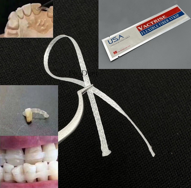 1pcs Dental Glass Fiber Splint Light Cure Composite Resin Bonding Strip Ribbond