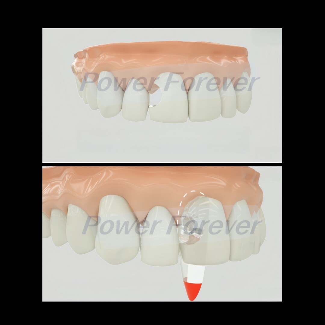 S2 Dental Anterior Distal Matrix Clear BT Bow Maxillary Matrices Contoured