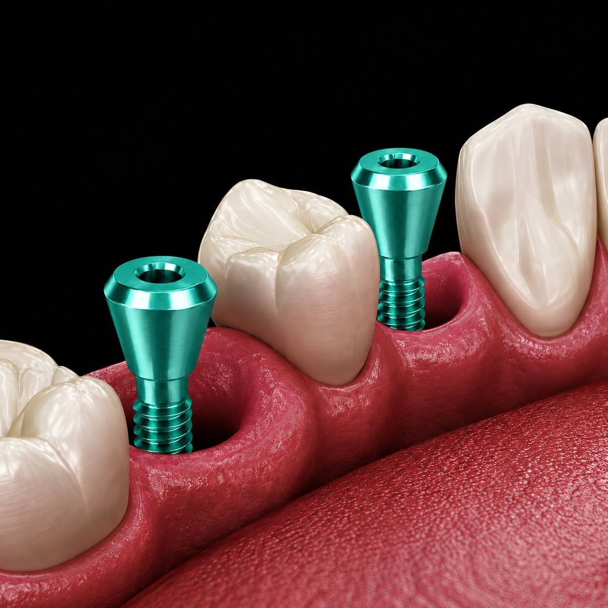 Multiple Implant Healing Abutment & Closure Cover Screw Hiossen Nobel Straumann