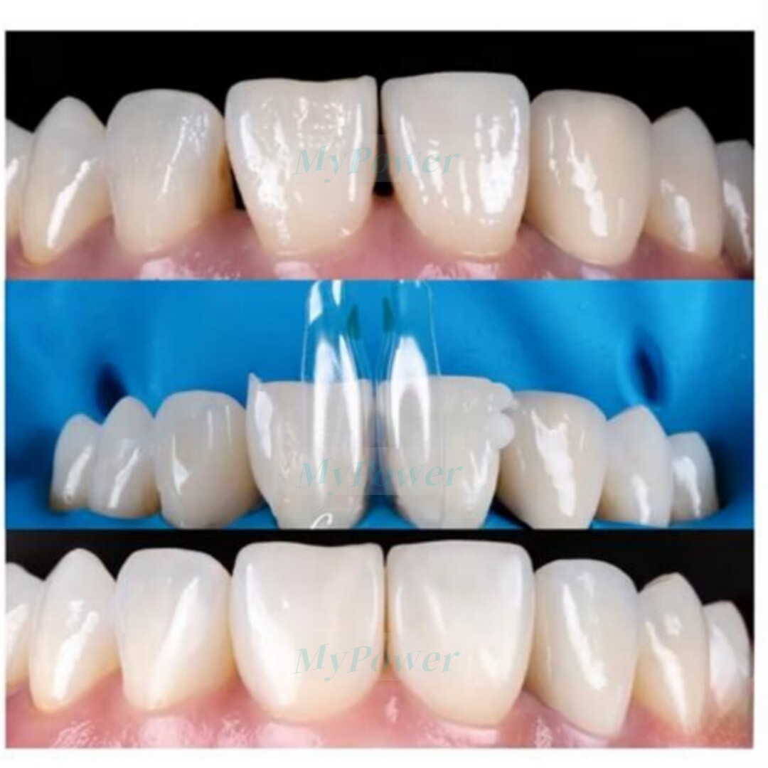 Dental Clear Matrix Anterior Posterior Teeth Matrix Wedges Kit Fit Bioclear BT