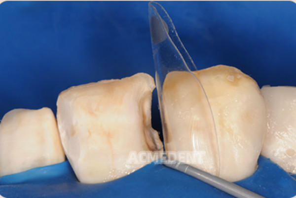 Dental Signet Anterior and Posterior Transparent Matrix Triall Molding Kit
