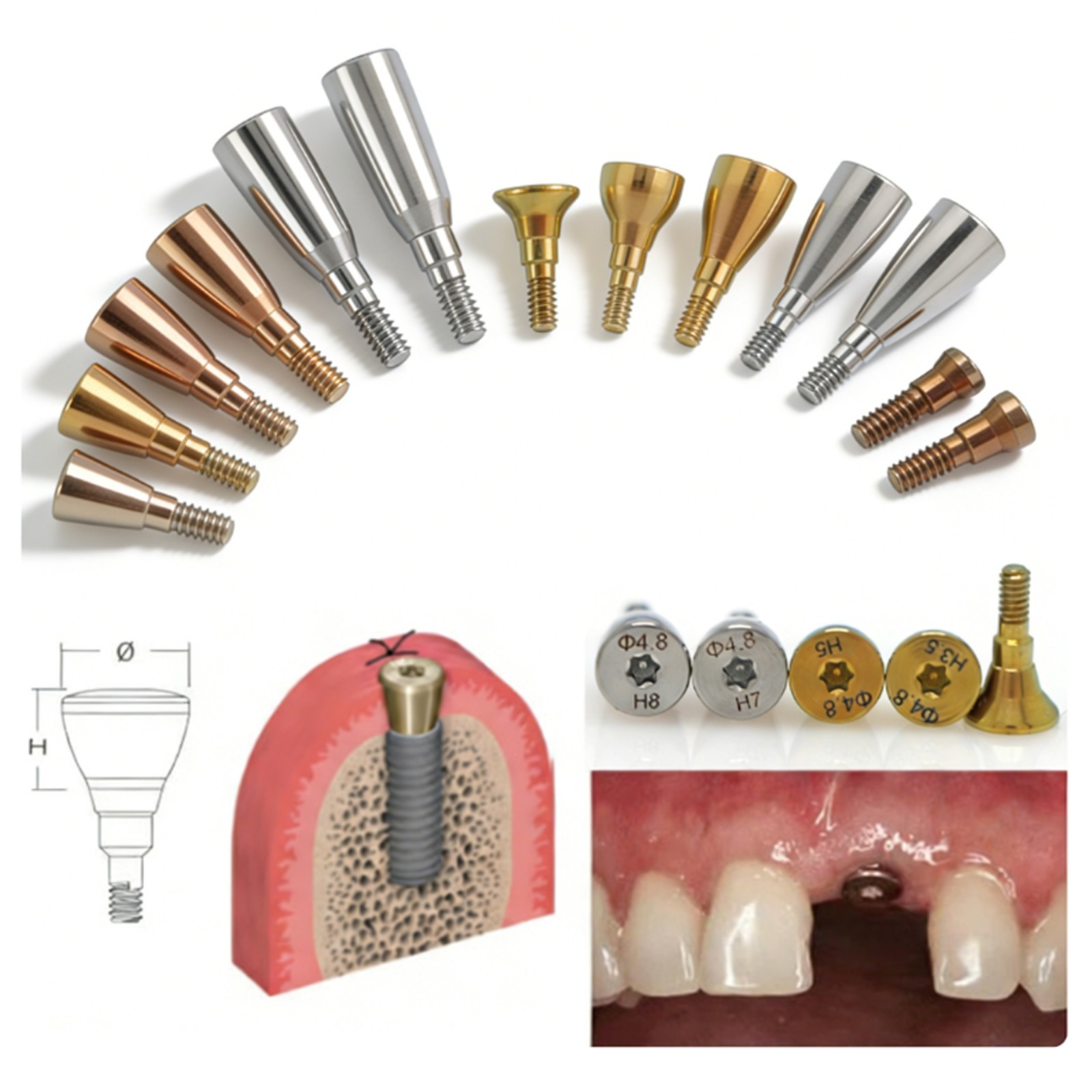 Dental NC Healing Abutment & Closure Cover Screw Straumann Bone Level BLT Ø3.3
