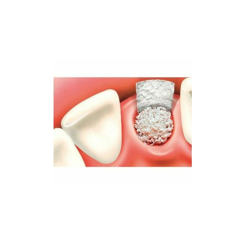 Dental SYNTOSS Tricalcium Phosphate Bone Graft Powder Impl ant