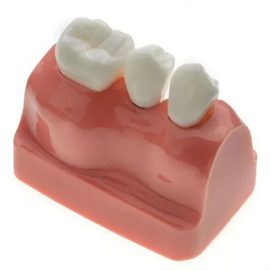 2Pc Dental Oral Analysis Crown Bridge Demonstration Tooth 4 Times Model Typodont