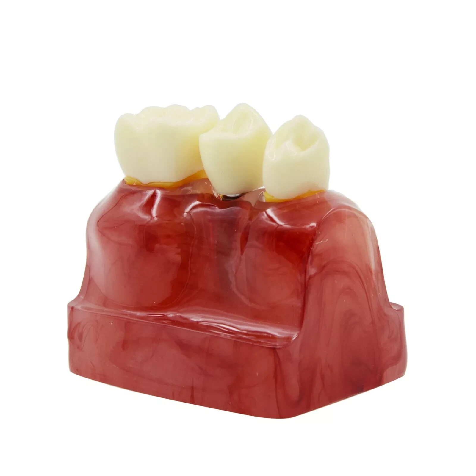 2Pc Dental Oral Analysis Crown Bridge Demonstration Tooth 4 Times Model Typodont
