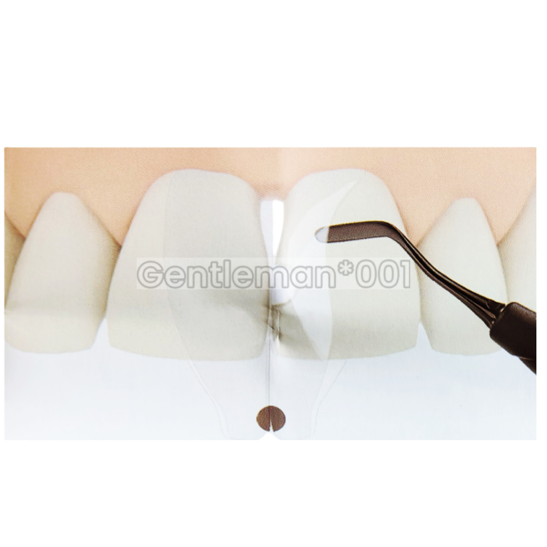 Dental Widening Front Tranparent Clear Matrix BT Matrices Fits BioClear S1/2/3