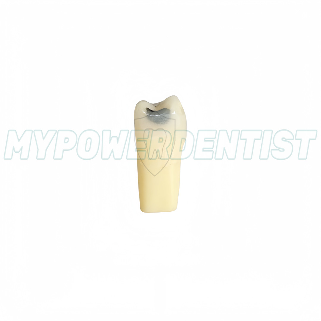 Dental Cavity Teeth Model Tooth Teaching Caries 25# Compatible Frasaco AG-3