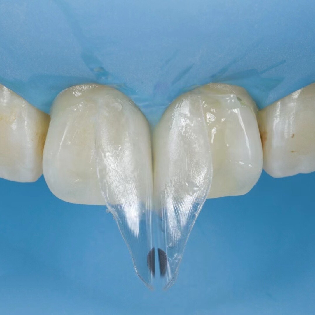 Dental Widening Front Tranparent Clear Matrix BT Matrices Fits BioClear S1
