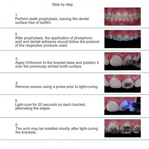 FGM Orthocem Light-Curing Orthodontic Cement for Brackets 4g Syringe