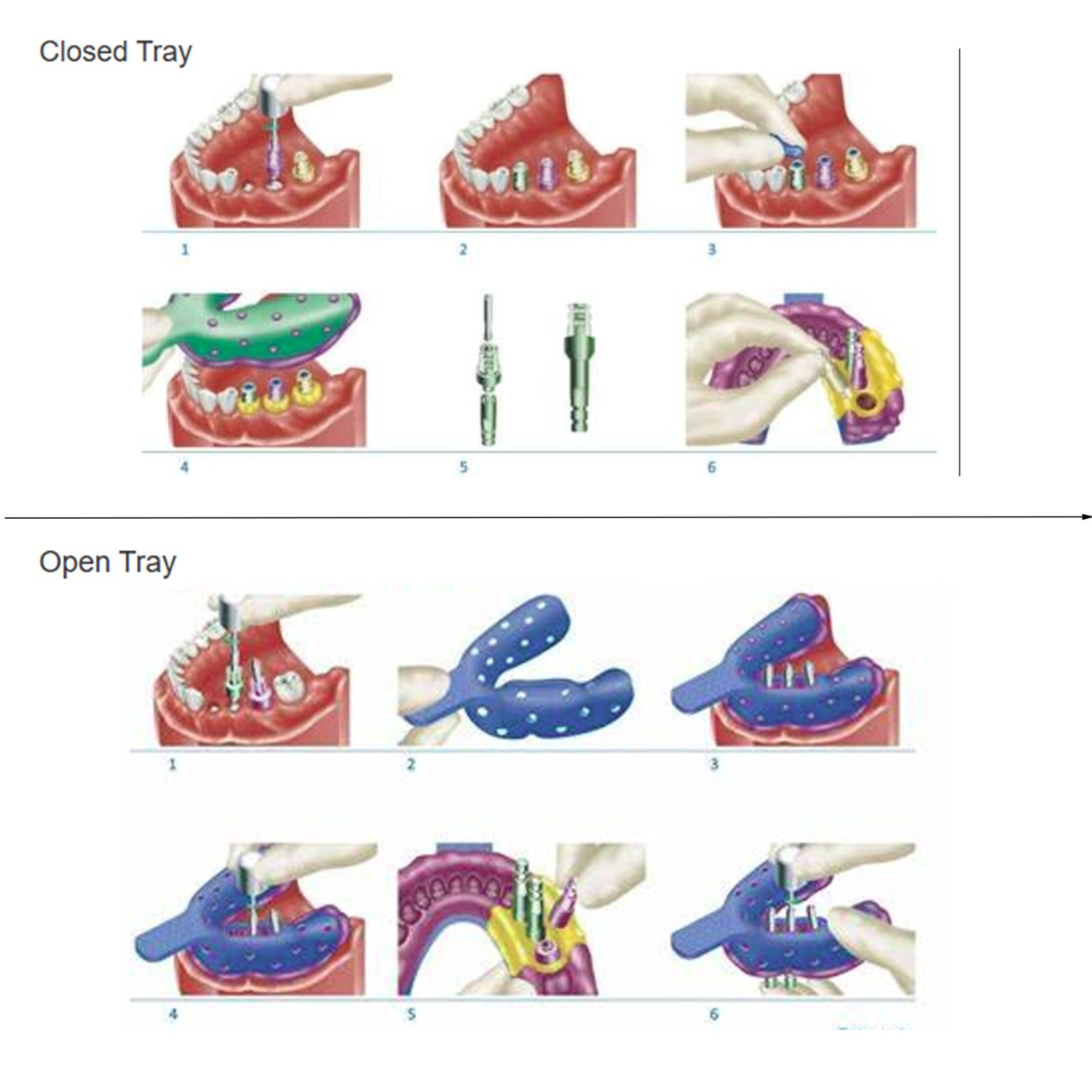US DIO UFII Dental Regular Fixture Transfer Impression Coping Open Closed Tray