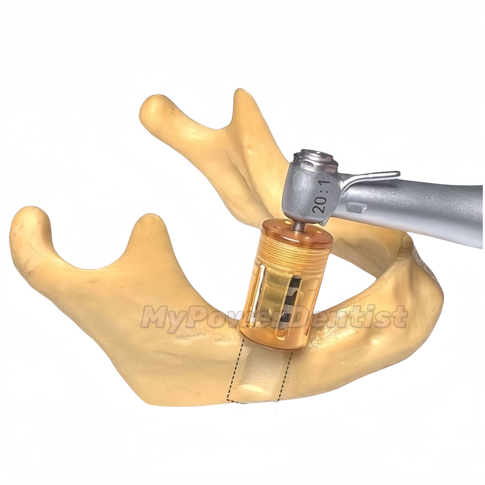 Dental SLT Half Moon Harvest Drill Semilunar Technique Collector Drills